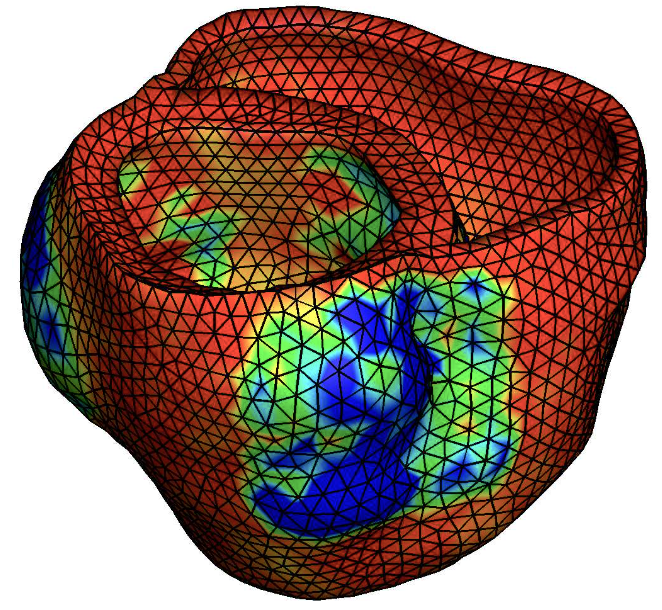 Coreform Cubit enables patient-specific cardiac models to combat heart disease